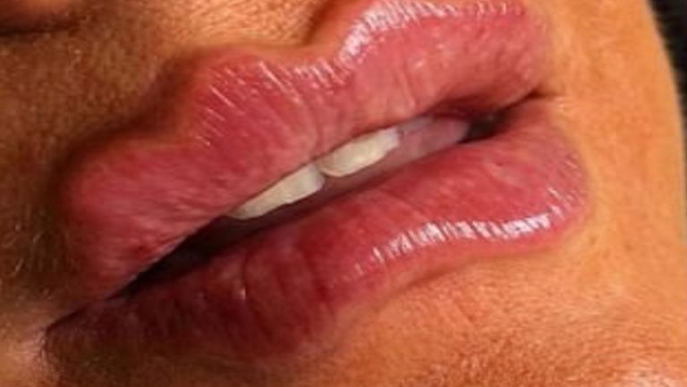 ‘Labios del diablo’, la peligrosa y controvertida moda que llegó de Rusia